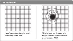 Midwest Eye Centers | Wet vs Dry Macular Degeneration | Chicago